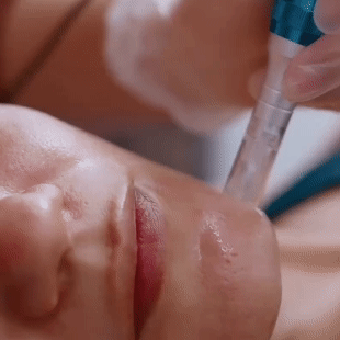 Dermapen Margiestetic